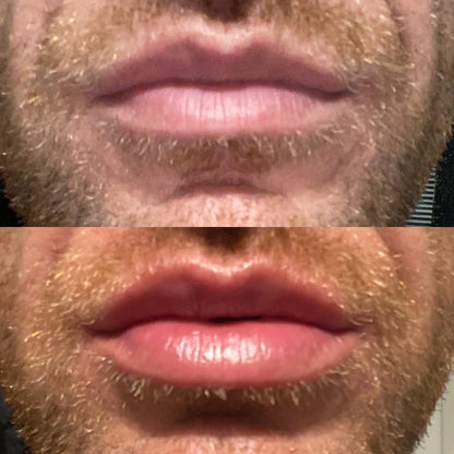 Rellenador de labios voluminizador®