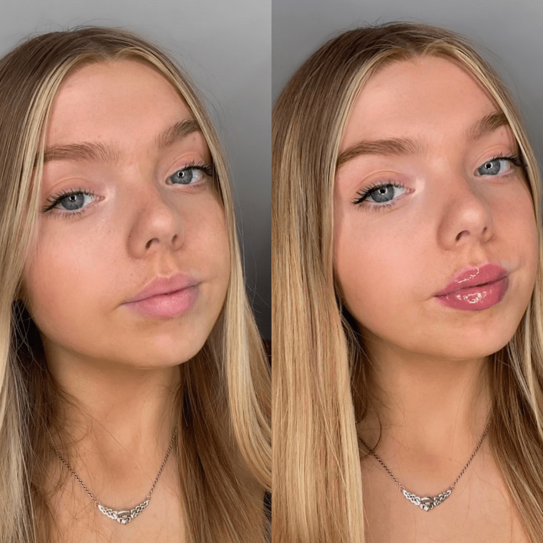 Rellenador de labios voluminizador®