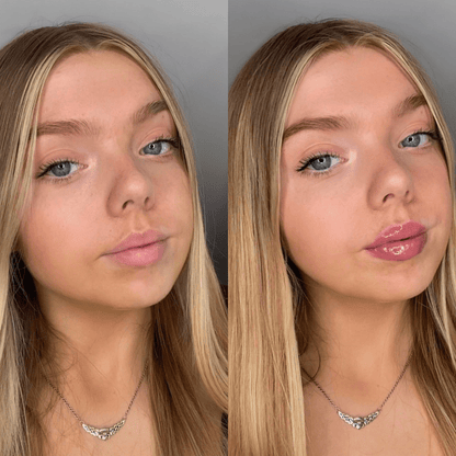 Rellenador de labios voluminizador®