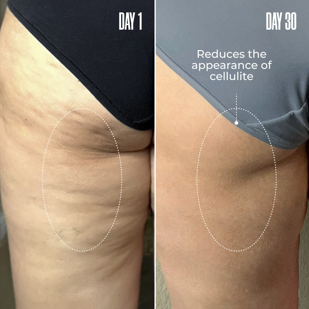 InfiniteLift® – Mascarilla Anticelulitis