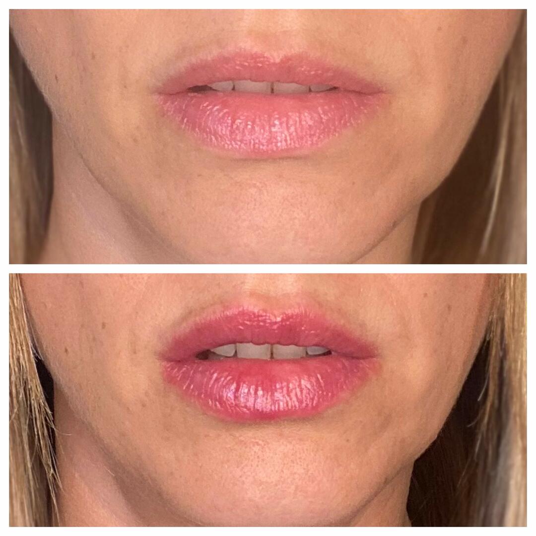 Rellenador de labios voluminizador®