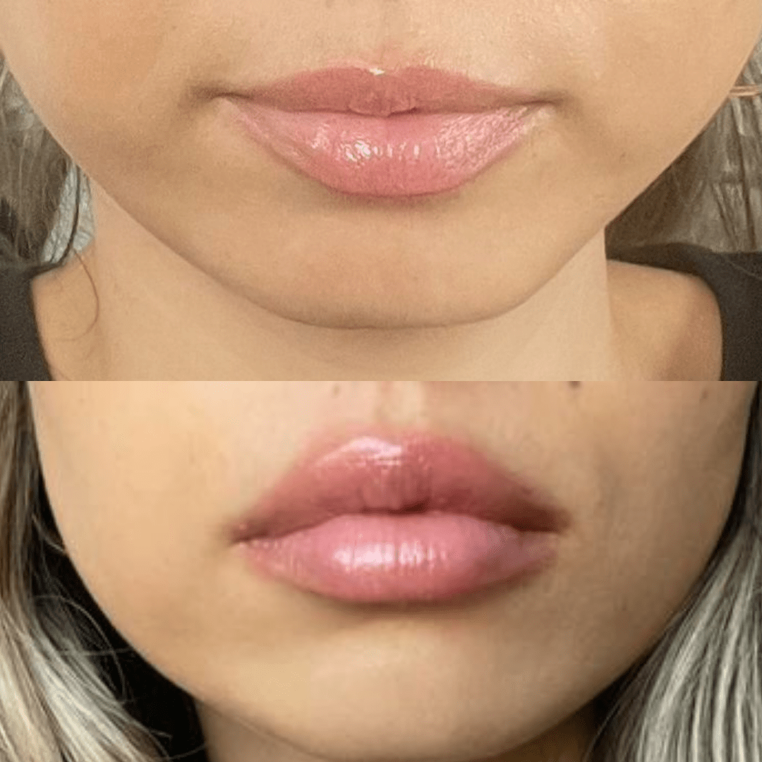 Rellenador de labios voluminizador®