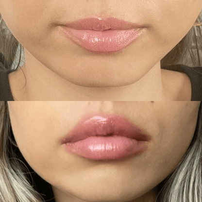 Rellenador de labios voluminizador®