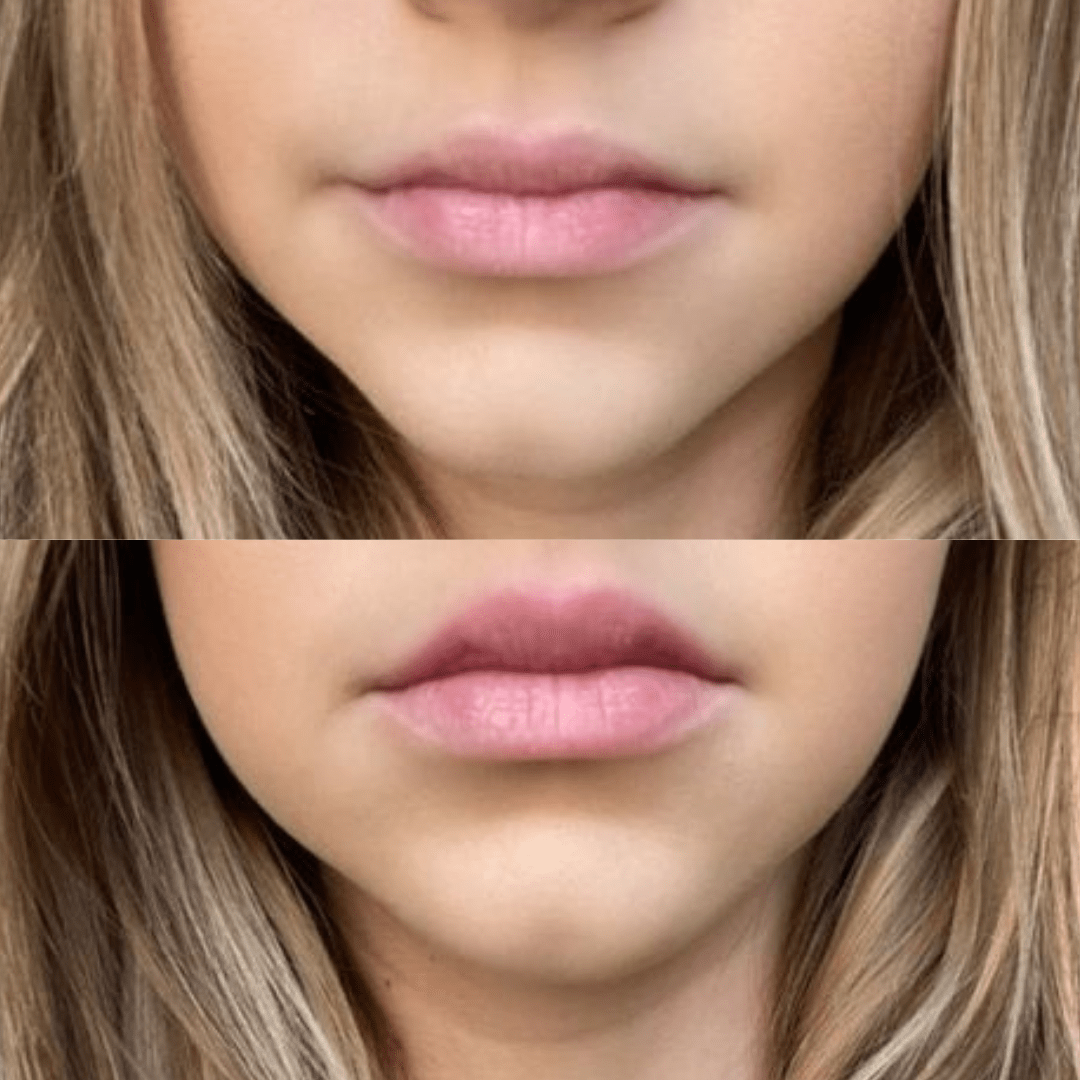 Rellenador de labios voluminizador®