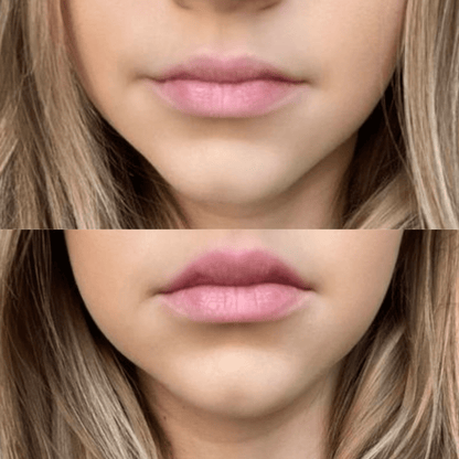 Rellenador de labios voluminizador®